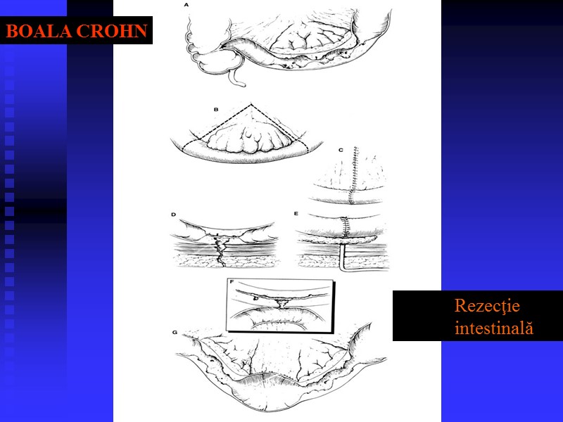 BOALA CROHN Rezecţie intestinală